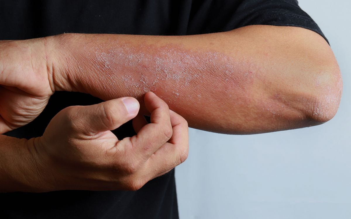 Neuer Allergie-Mechanismus entschlsselt - Universittsklinik fr  Dermatologie